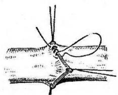 Suture material Vascular suture